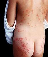 example of sea bathers rash